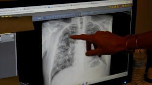 In US mining hub, black lung rates soar